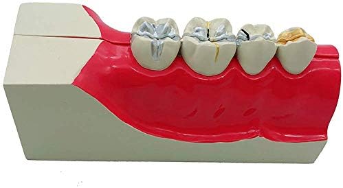 K99 2 Pcs Diş Sinir Hattı Modeli Diş Molar Kesit Diş Modeli Sağ Alt Arka Diş Doku Ayrışma için Çalışma Öğretmek Gösteri